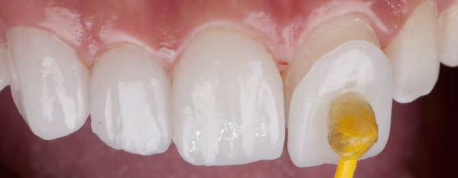 Understanding Dental Veneers