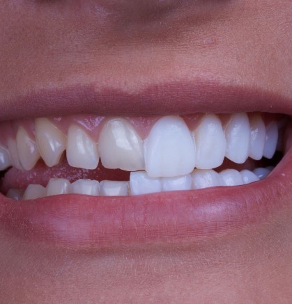 Understanding Dental Veneers, dental shells, cosmetic tooth covering, tooth restoration, dental aesthetics, smile enhancement, dental bonding, porcelain veneers, composite veneers, tooth imperfections, dental transformation, dental procedure, dental treatment, dental options, dental solution, dental craftsmanship, tooth improvement, dental alternatives, aesthetic dentistry, dental materials, naturallooking smile, dental defects, dental makeover, dental restoration, dental experts